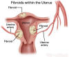 Shrinking Uterine Fibroids with Para-Tan